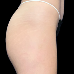 Emsculpt Neo Before & After Patient #7534
