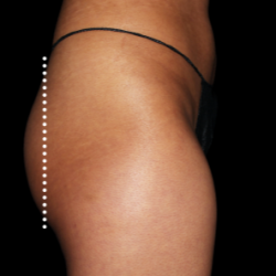 Emsculpt Neo Before & After Patient #7535