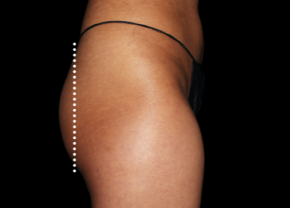 Emsculpt Neo Before & After Patient #7535