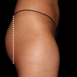 Emsculpt Neo Before & After Patient #7535