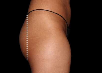 Emsculpt Neo Before & After Patient #7535