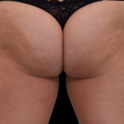 Emsculpt Neo Before & After Patient #7536
