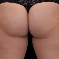 Emsculpt Neo Before & After Patient #7536