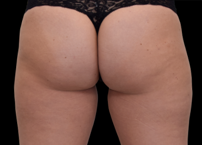 Emsculpt Neo Before & After Patient #7536