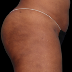 Emsculpt Neo Before & After Patient #7538