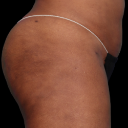Emsculpt Neo Before & After Patient #7538