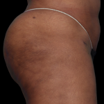 Emsculpt Neo Before & After Patient #7538