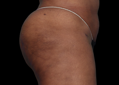 Emsculpt Neo Before & After Patient #7538