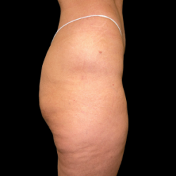 Emsculpt Neo Before & After Patient #7539
