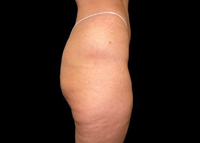 Emsculpt Neo Before & After Patient #7539