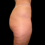 Emsculpt Neo Before & After Patient #7539