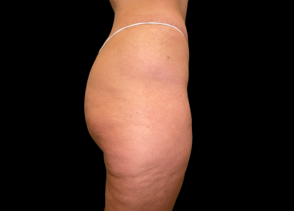 Emsculpt Neo Before & After Patient #7539