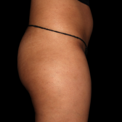 Emsculpt Neo Before & After Patient #7541