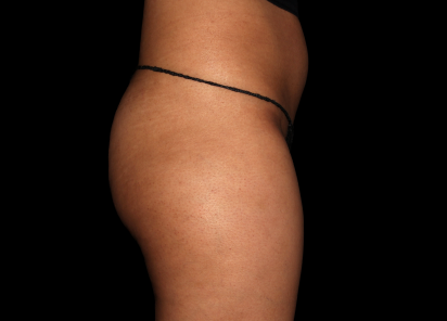 Emsculpt Neo Before & After Patient #7541