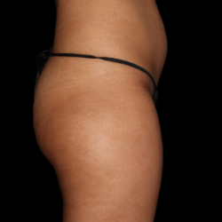 Emsculpt Neo Before & After Patient #7541