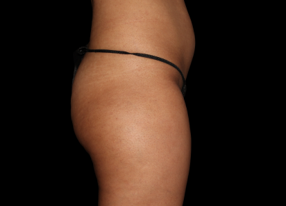 Emsculpt Neo Before & After Patient #7541
