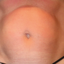 Emsculpt Neo Before & After Patient #7485