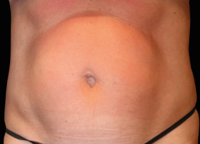 Emsculpt Neo Before & After Patient #7485