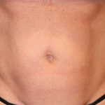 Emsculpt Neo Before & After Patient #7485