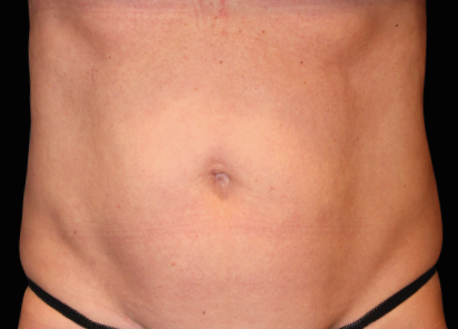 Emsculpt Neo Before & After Patient #7485