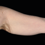 Emsculpt Neo Before & After Patient #7543