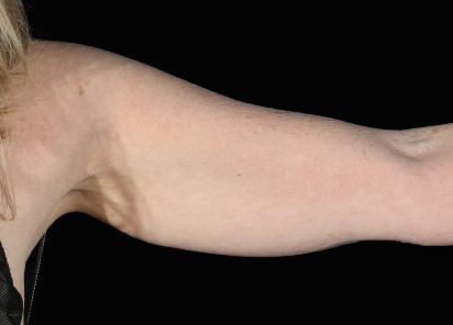 Emsculpt Neo Before & After Patient #7543