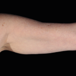 Emsculpt Neo Before & After Patient #7543