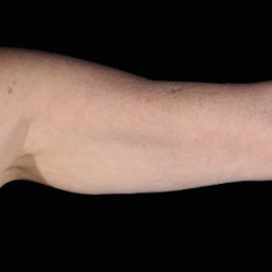 Emsculpt Neo Before & After Patient #7543