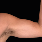 Emsculpt Neo Before & After Patient #7544