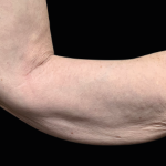 Emsculpt Neo Before & After Patient #7545