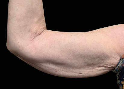 Emsculpt Neo Before & After Patient #7545