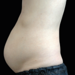 Emsculpt Neo Before & After Patient #7487