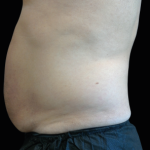 Emsculpt Neo Before & After Patient #7487
