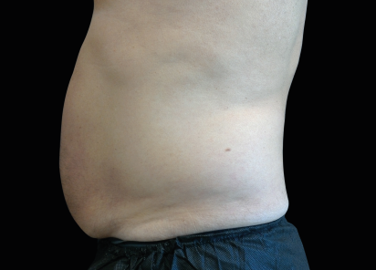 Emsculpt Neo Before & After Patient #7487