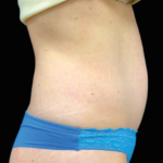 Emsculpt Neo Before & After Patient #7489