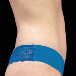 Emsculpt Neo Before & After Patient #7489