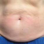 Emsculpt Neo Before & After Patient #7490
