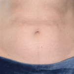 Emsculpt Neo Before & After Patient #7490