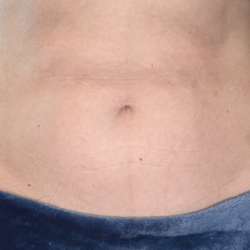 Emsculpt Neo Before & After Patient #7490