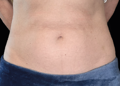 Emsculpt Neo Before & After Patient #7490
