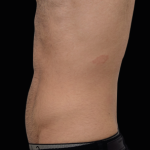 Emsculpt Neo Before & After Patient #7492