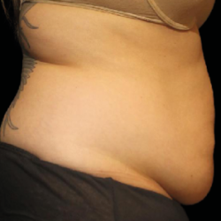 Emsculpt Neo Before & After Patient #7494