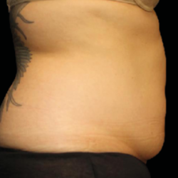 Emsculpt Neo Before & After Patient #7494