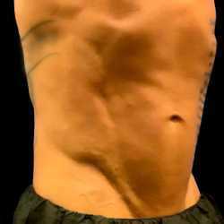 Emsculpt Neo Before & After Patient #7496