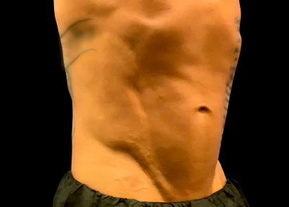 Emsculpt Neo Before & After Patient #7496
