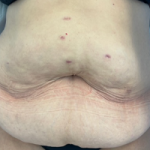 Abdominoplasty Before & After Patient #7727