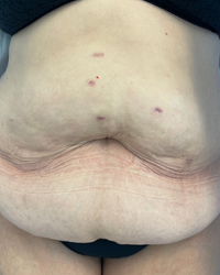 Abdominoplasty Before & After Patient #7727