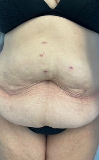 Abdominoplasty Before & After Patient #7727