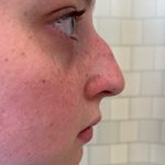 Rhinoplasty Before & After Patient #7713