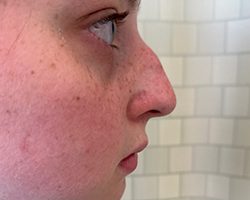 Rhinoplasty Before & After Patient #7713